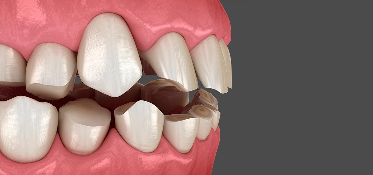 signos que alertan de la existencia de un desgaste dental severo