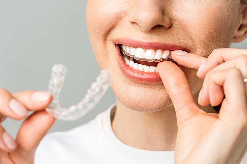 10 Tips para limpiar las férulas del tratamiento Invisalign