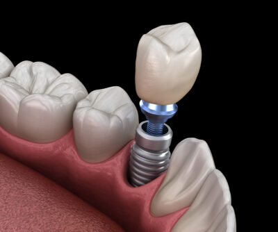colocacion corona sobre implante dental