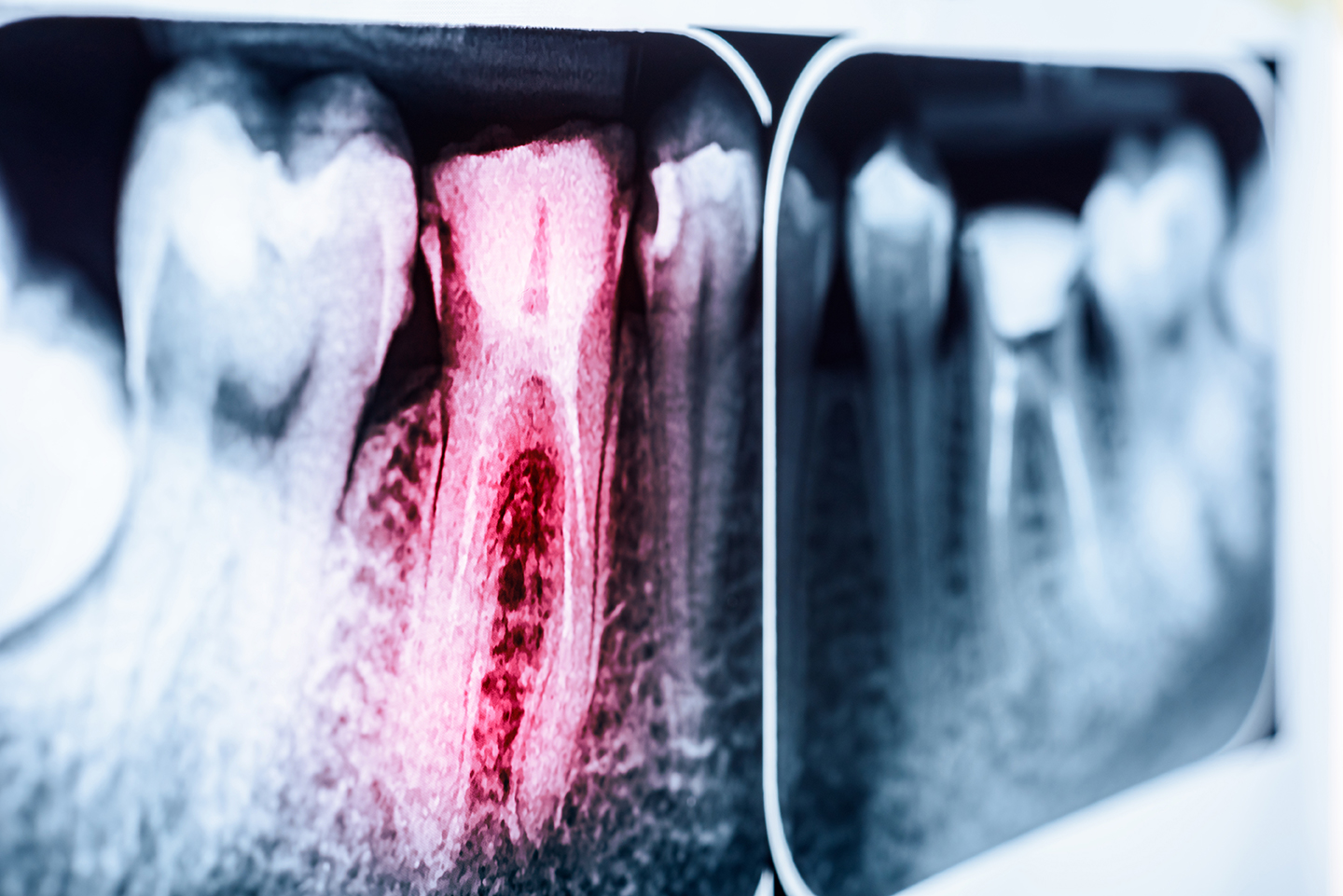 endodoncia-radiografia