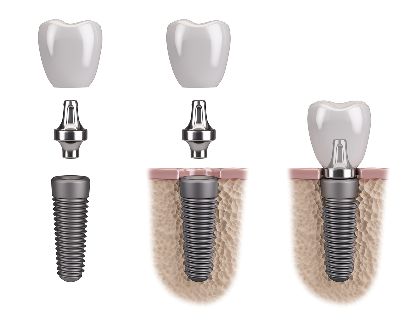 tipos implantes dentales colocacion