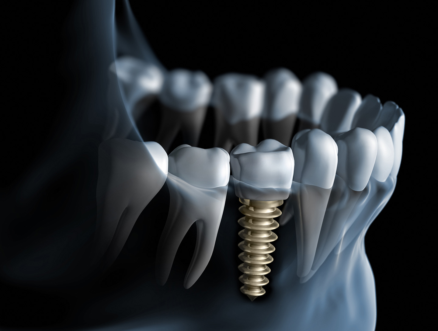 procedimiento-colocacion-implantes-dentales