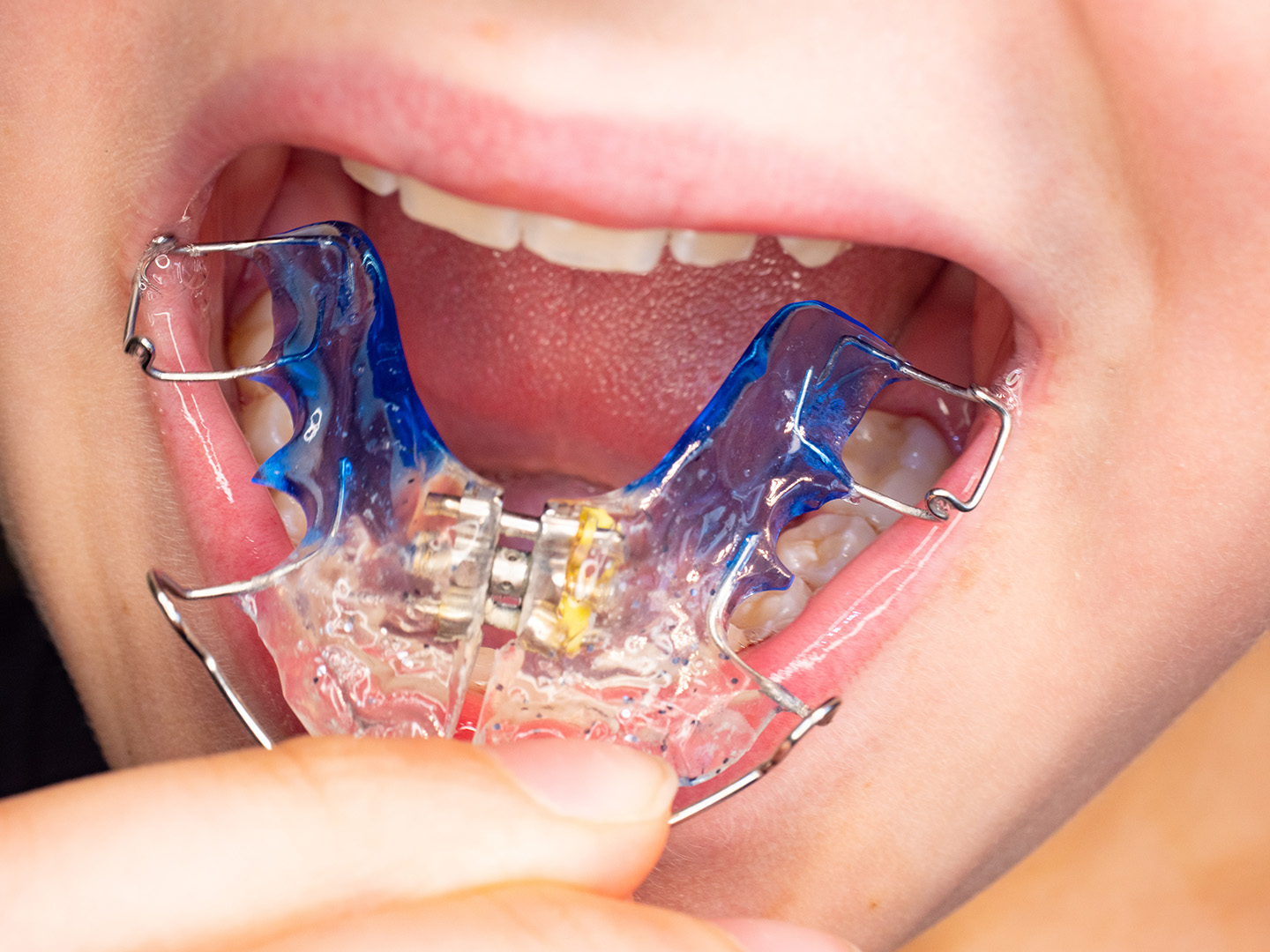 ortodoncia-funcional