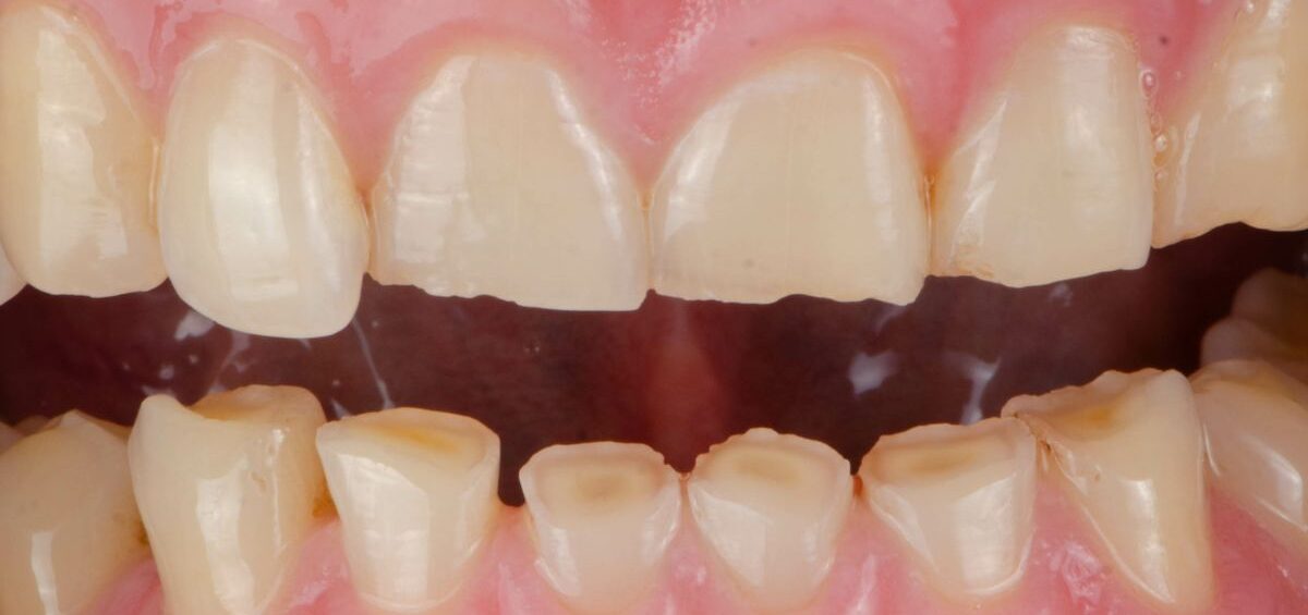 dientes-desgastados