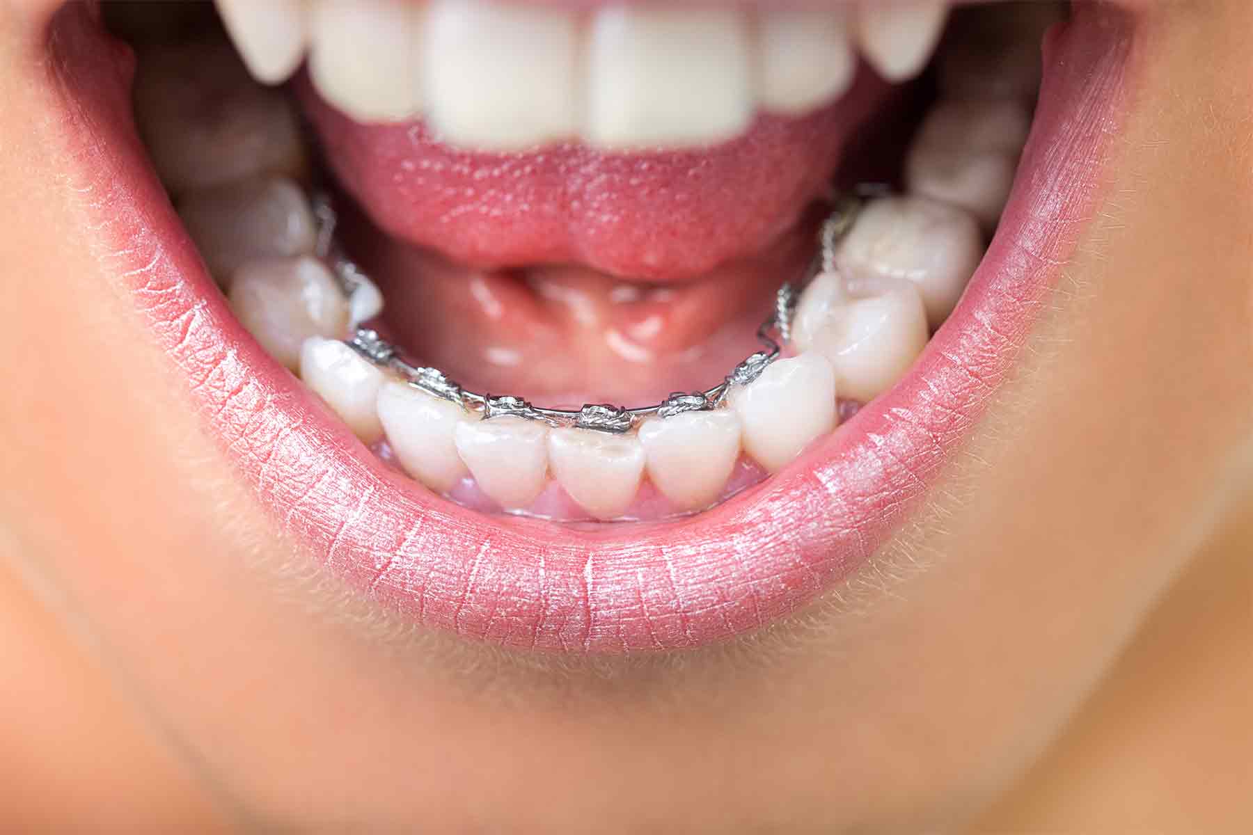ortodoncia-invisible-lingual