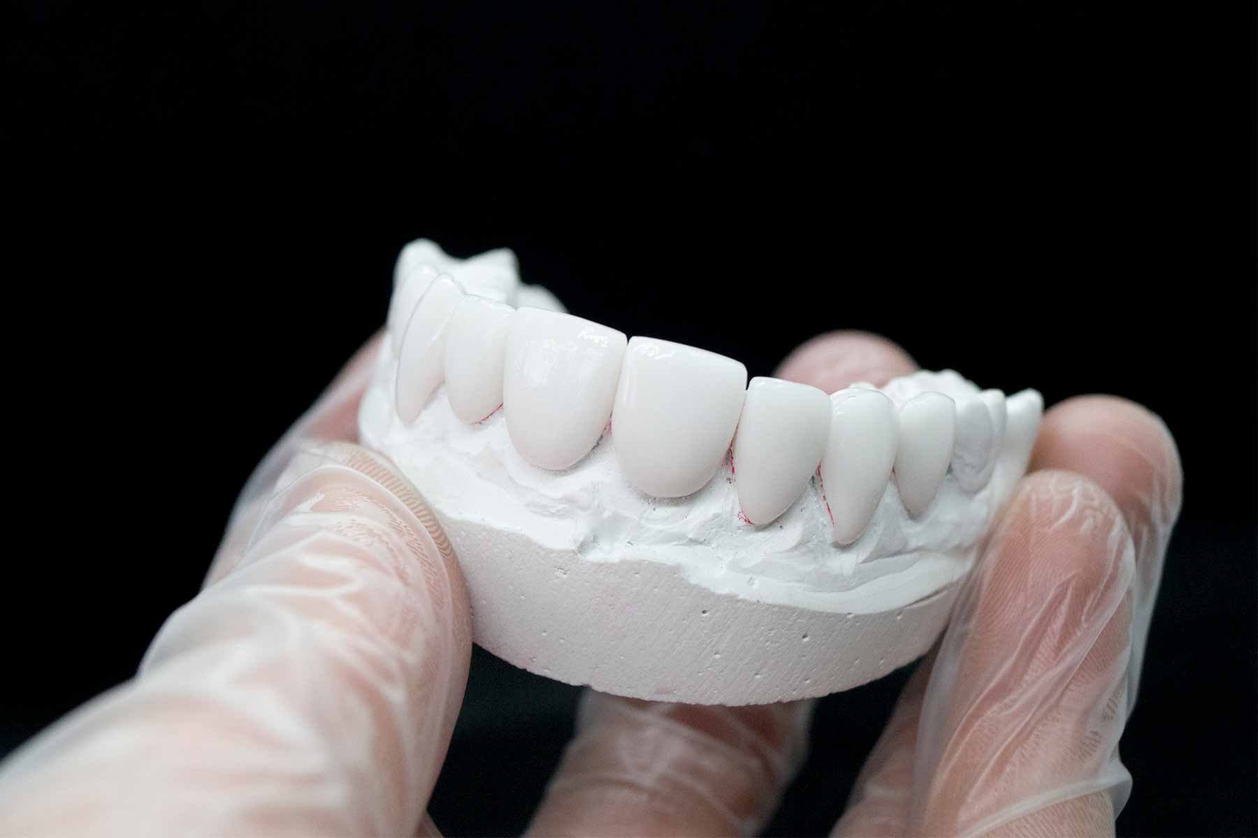 Carillas colocadas en una dentadura