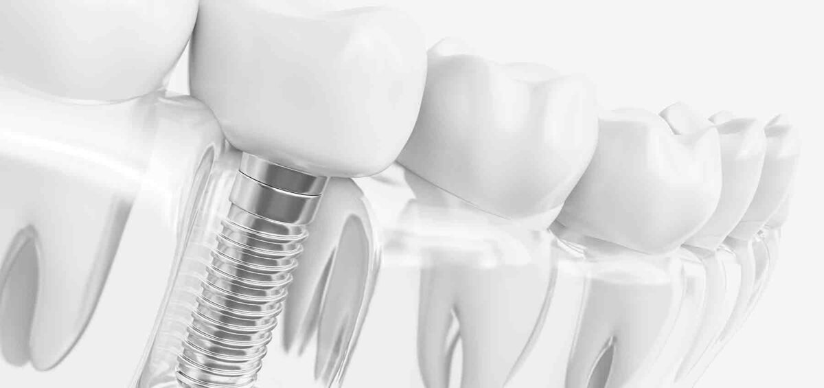 Implante con corona dental