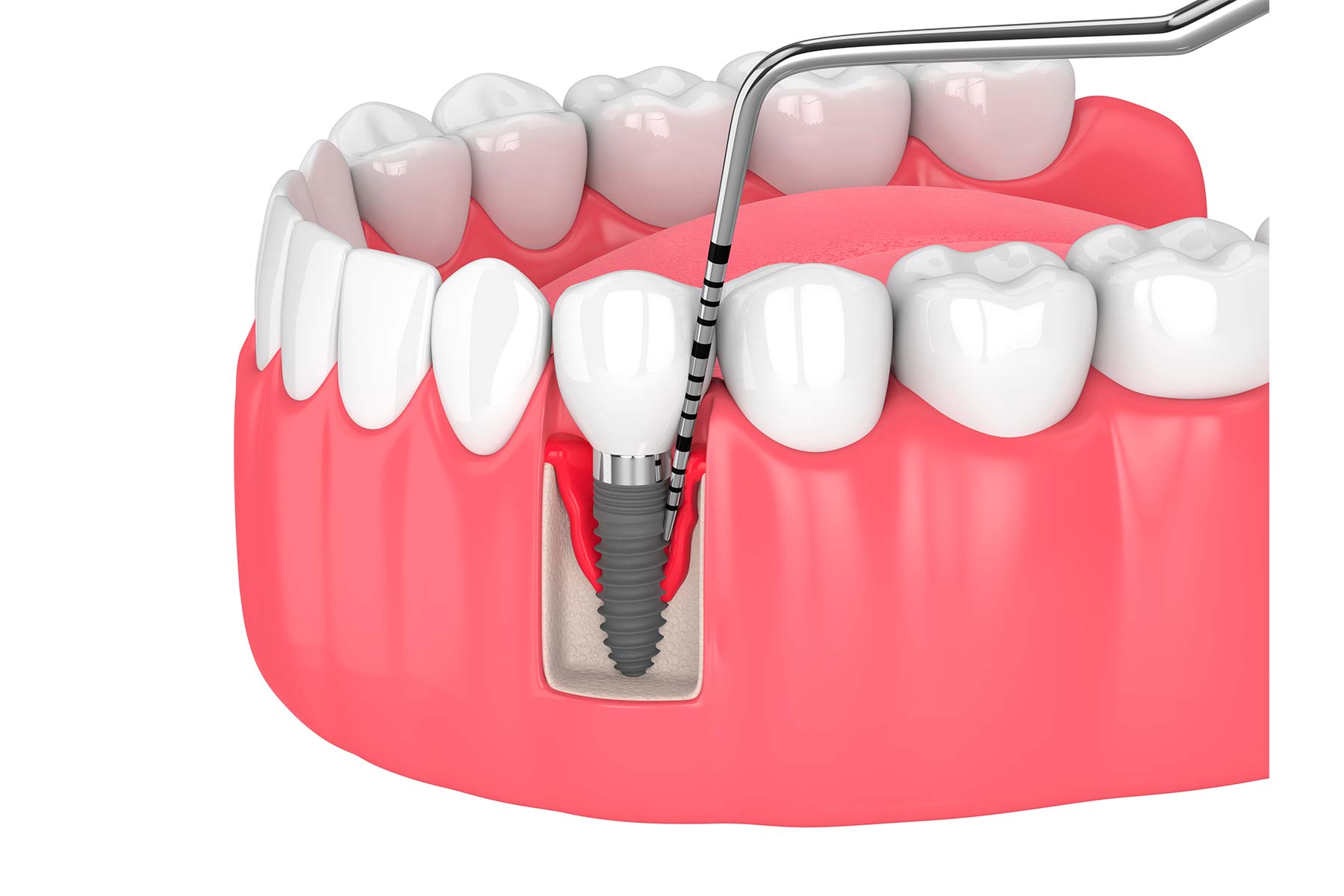 Encía con periimplantitis