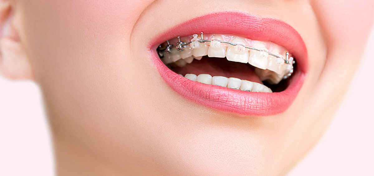 mujer sonriendo con brackets estéticos