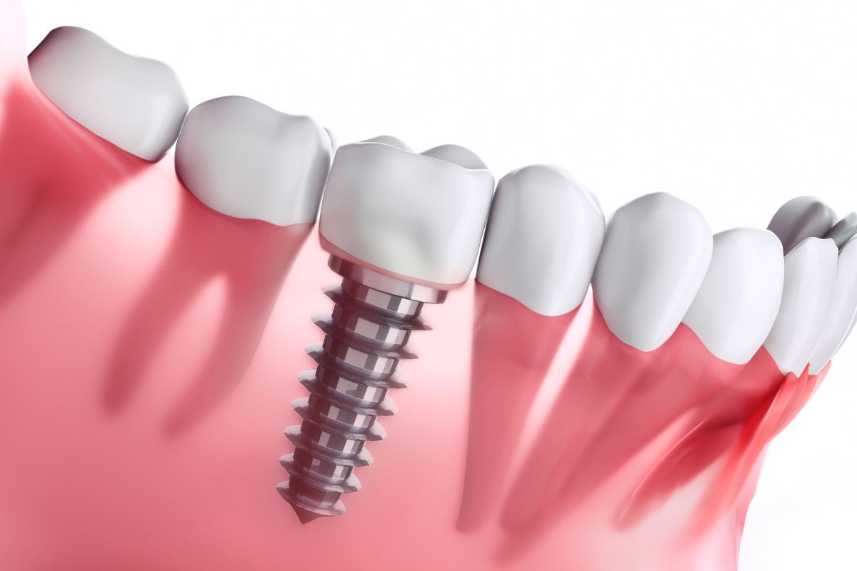 factores-influyen-implante-dental
