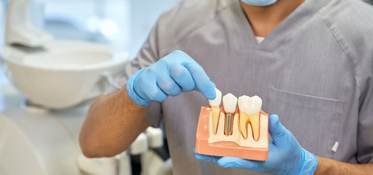 implantes-dentales