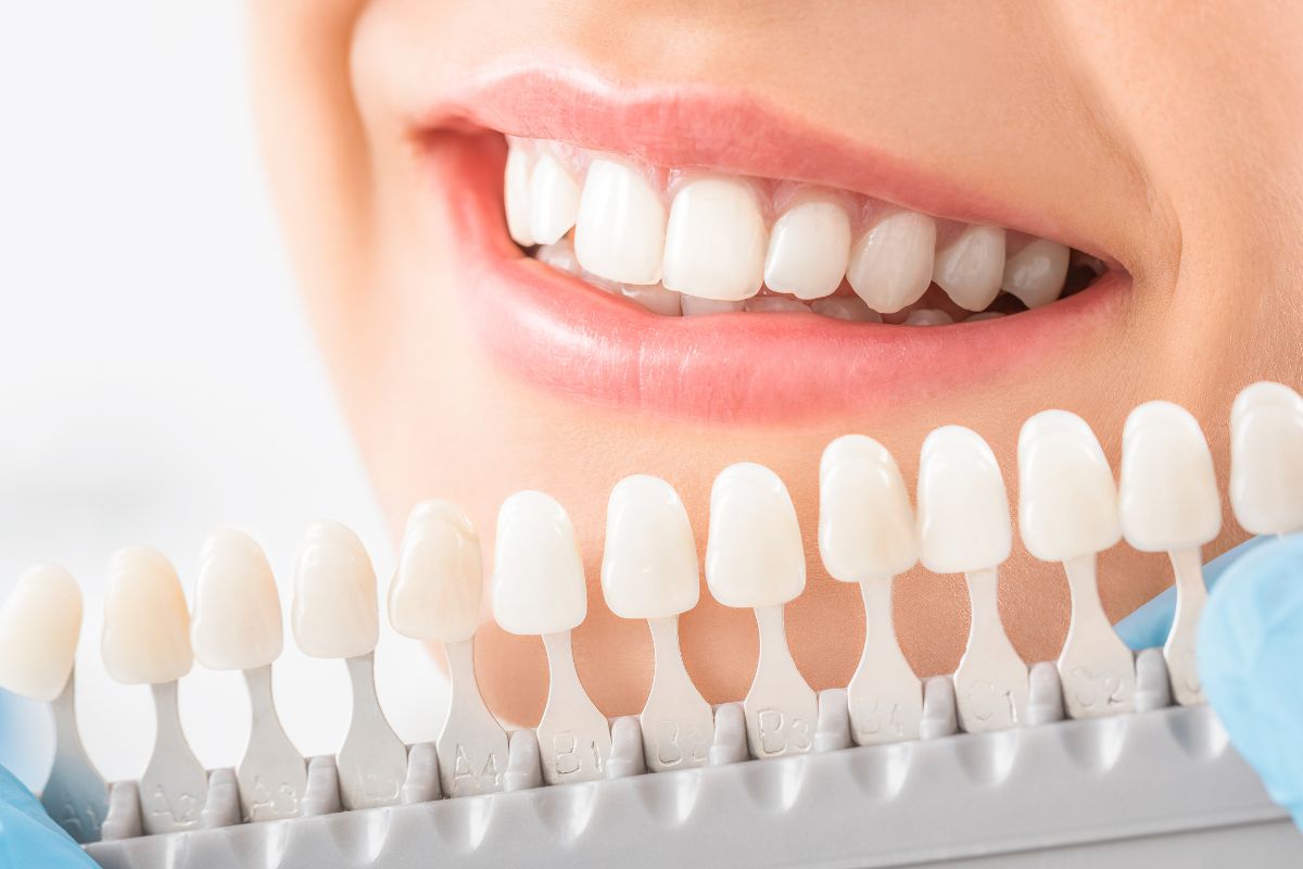 ventajas-blanqueamiento-dental