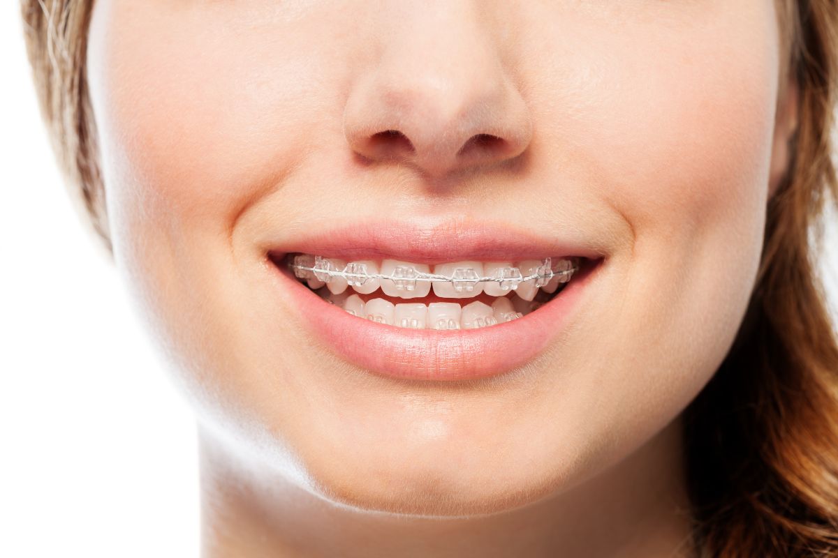 brackets-esteticos