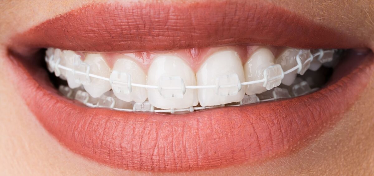 sonrisa son brackets dentales transparentes