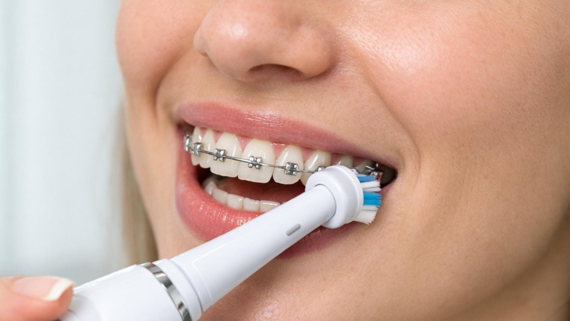 cepillado de brackets con cepillo eléctrico.