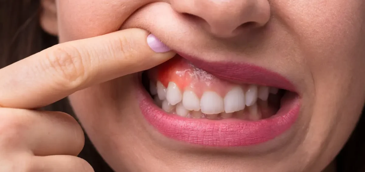 mujer mostrando sus encías hinchadas por periodoncia